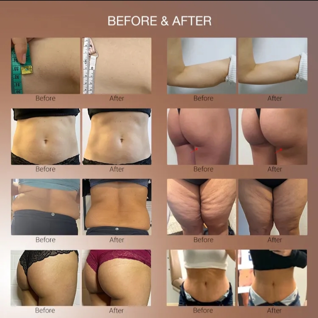 Renasculpt result 1