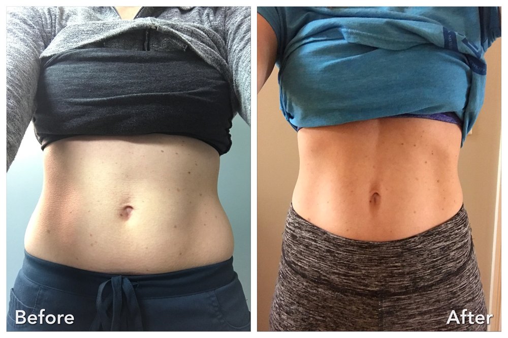Renasculpt result 4