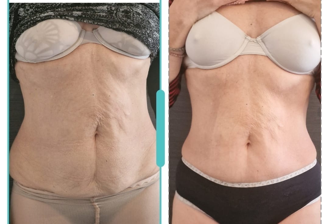 Renasculpt result 5